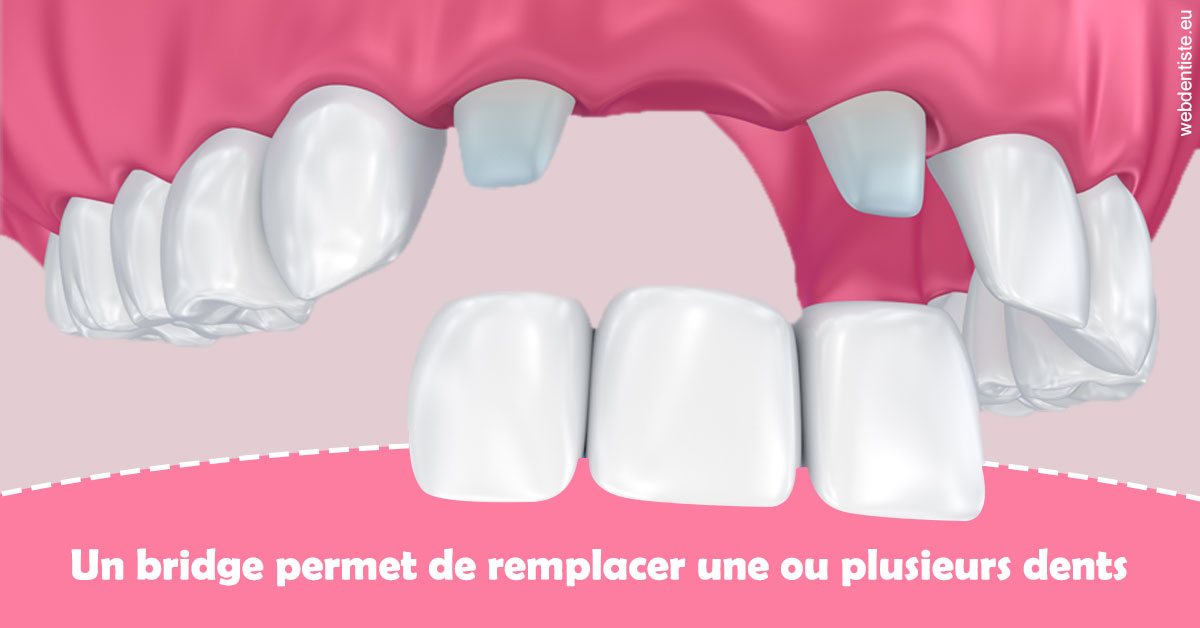https://www.orthodontiste-nogentsurmarne.com/Bridge remplacer dents 2