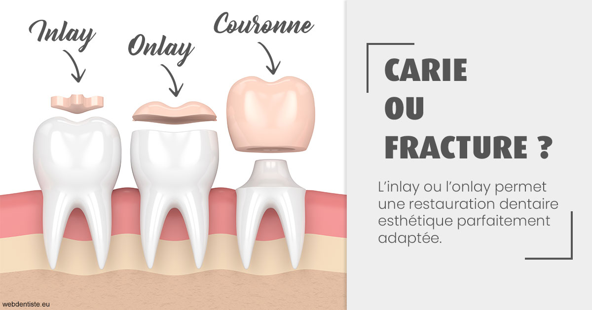 https://www.orthodontiste-nogentsurmarne.com/T2 2023 - Carie ou fracture 1
