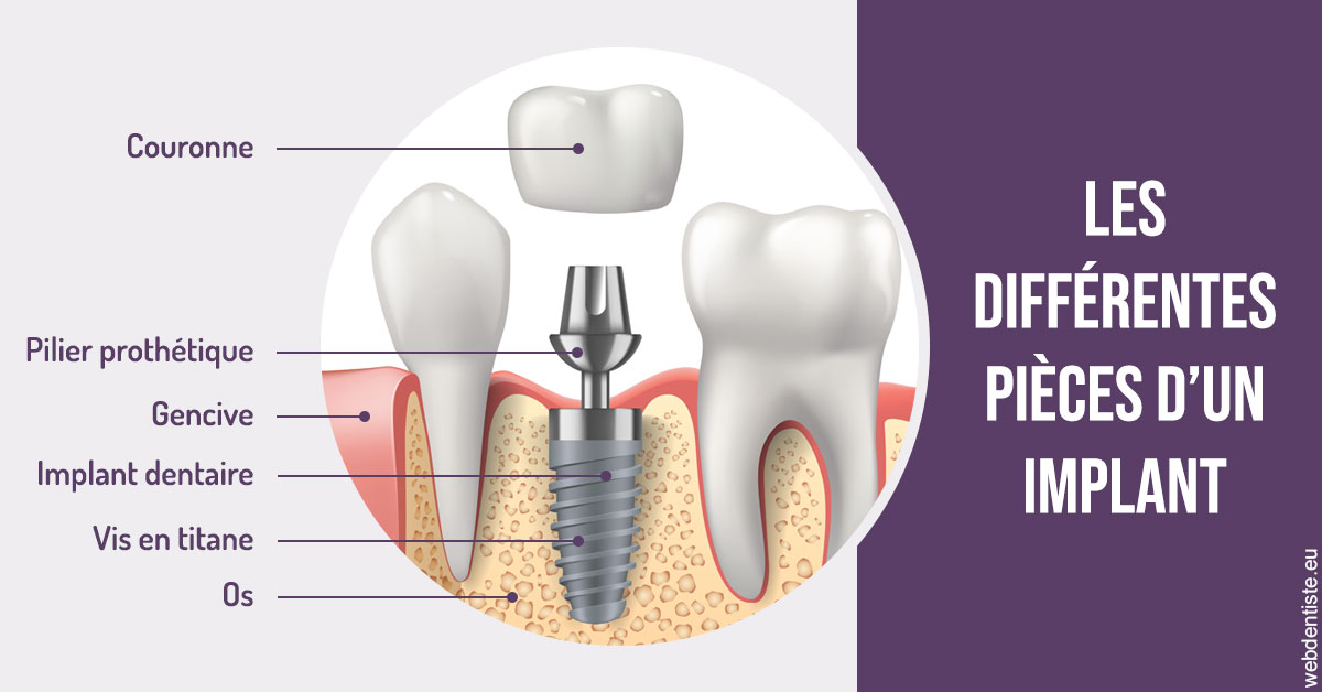 https://www.orthodontiste-nogentsurmarne.com/Les différentes pièces d’un implant 2
