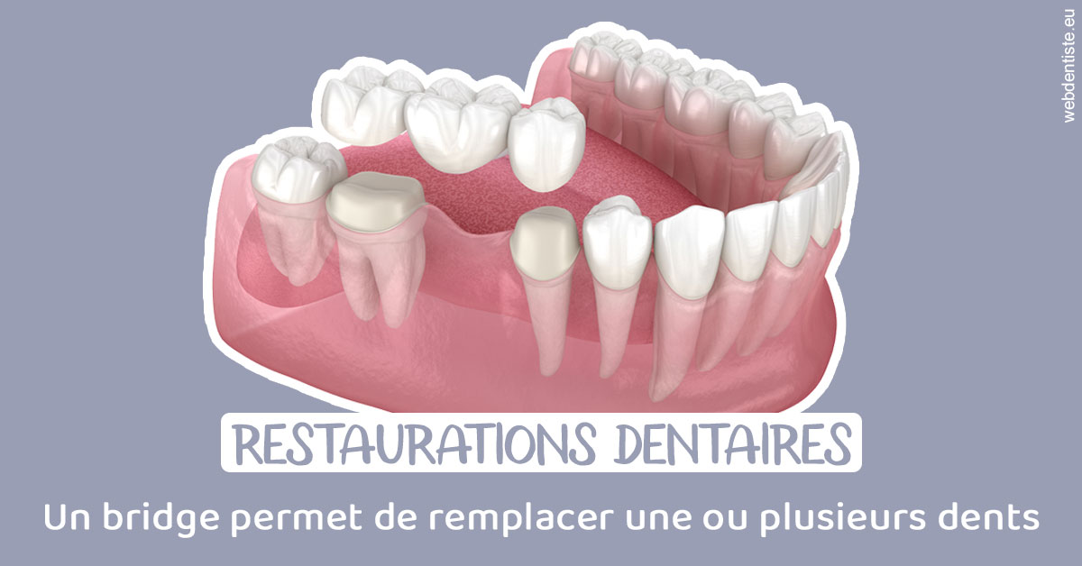 https://www.orthodontiste-nogentsurmarne.com/Bridge remplacer dents 1