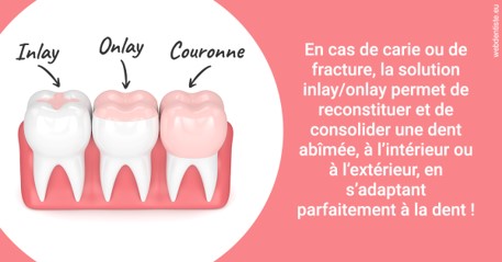 https://www.orthodontiste-nogentsurmarne.com/L'INLAY ou l'ONLAY 2