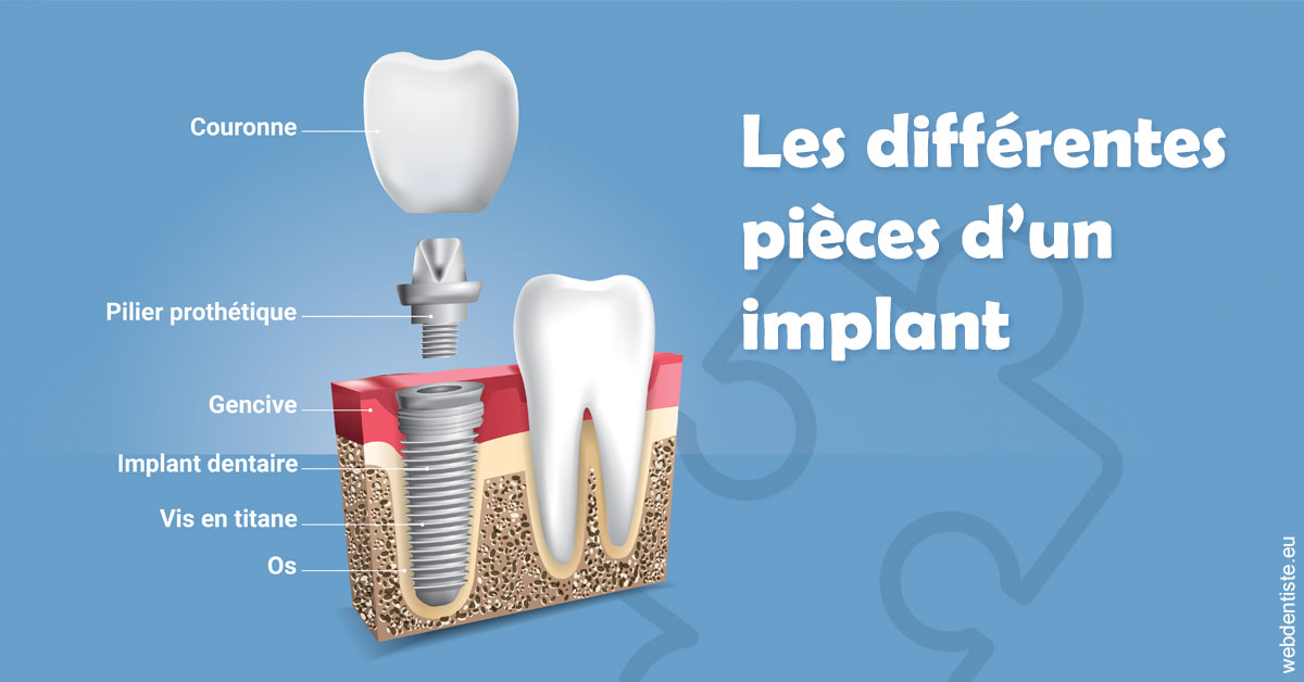 https://www.orthodontiste-nogentsurmarne.com/Les différentes pièces d’un implant 1