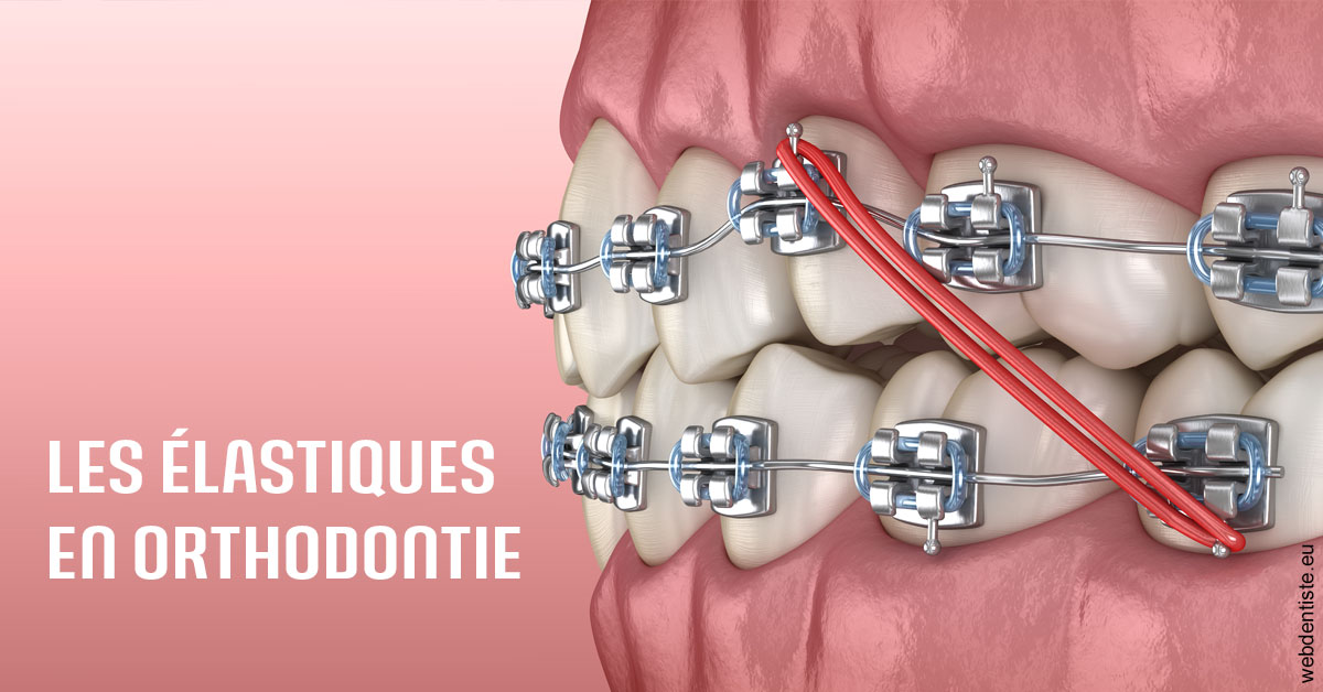 https://www.orthodontiste-nogentsurmarne.com/Elastiques orthodontie 2